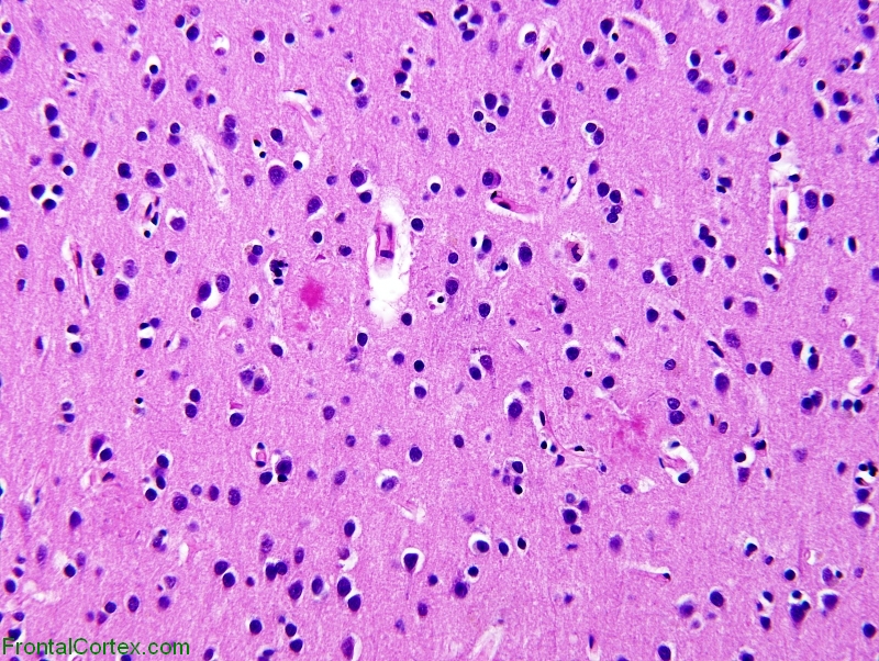 AD Occipital Cortex 200x